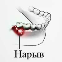 Нарыв в десне лечение в домашних условиях Нарыв в десне лечение в домашних условиях