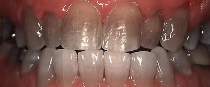 Причины появления тетрациклиновых зубов и методы их лечения