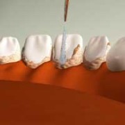 Чистка зубных отложений