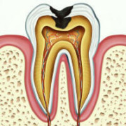 Зуб с хроническим пульпитом