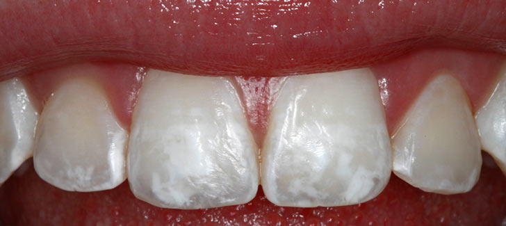 Опасность белых пятен на зубах у детей, причины и виды лечения
