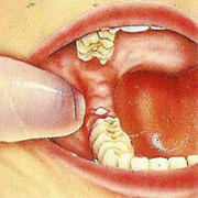 Удаленный зуб
