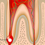 Периодонтит зуба